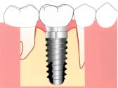 インプラント